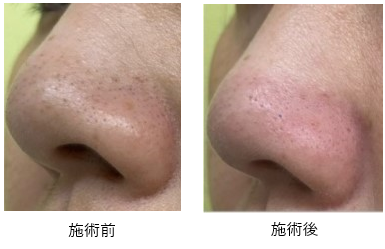 施術前後